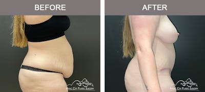 Liposuction Before & After Gallery - Patient 124877 - Image 3