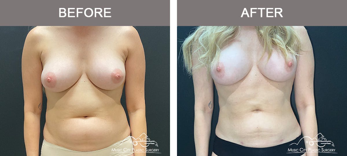Liposuction Before & After Gallery - Patient 347416 - Image 1