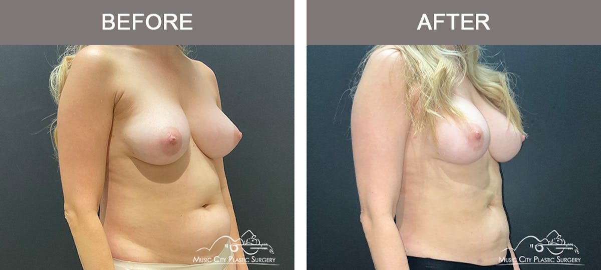Liposuction Before & After Gallery - Patient 347416 - Image 2