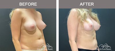Liposuction Before & After Gallery - Patient 347416 - Image 2