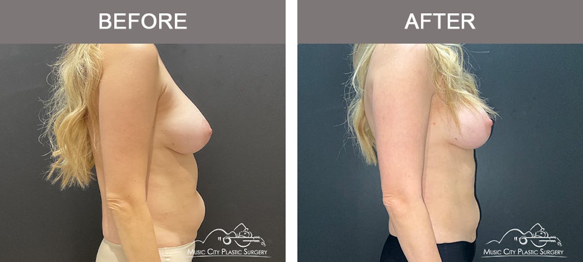 Liposuction Before & After Gallery - Patient 347416 - Image 3