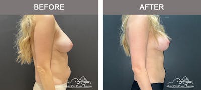 Liposuction Before & After Gallery - Patient 347416 - Image 3