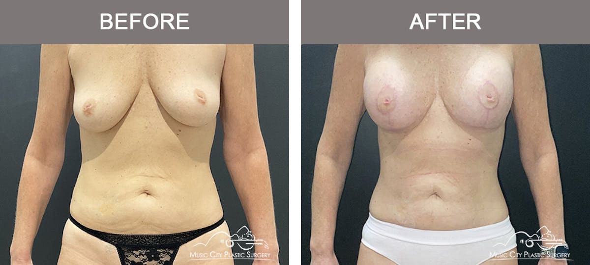 Liposuction Before & After Gallery - Patient 743798 - Image 1