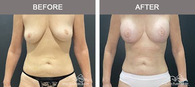 Liposuction Before & After Gallery - Patient 743798 - Image 1