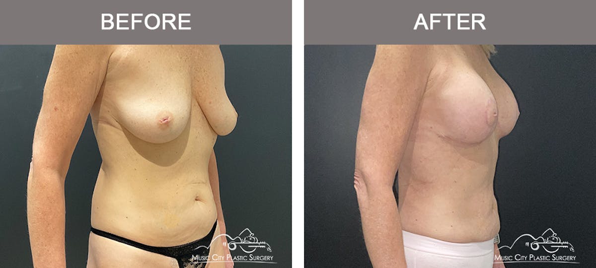 Liposuction Before & After Gallery - Patient 743798 - Image 2