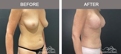 Liposuction Before & After Gallery - Patient 743798 - Image 2