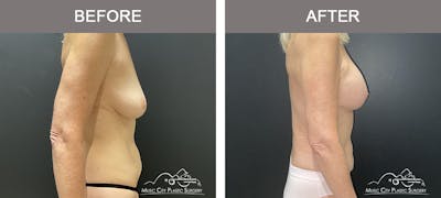 Liposuction Before & After Gallery - Patient 743798 - Image 3