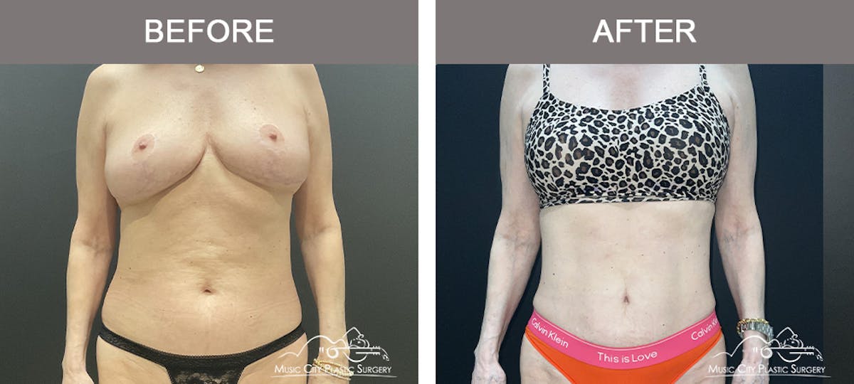 Liposuction Before & After Gallery - Patient 144174 - Image 1