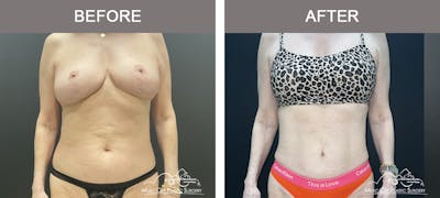 Liposuction Before & After Gallery - Patient 144174 - Image 1