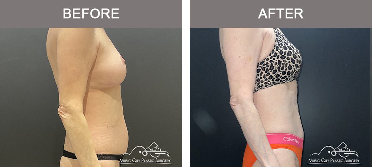 Liposuction Before & After Gallery - Patient 144174 - Image 2