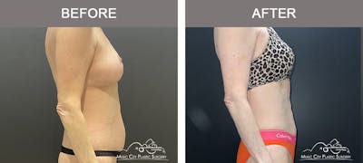 Liposuction Before & After Gallery - Patient 144174 - Image 2