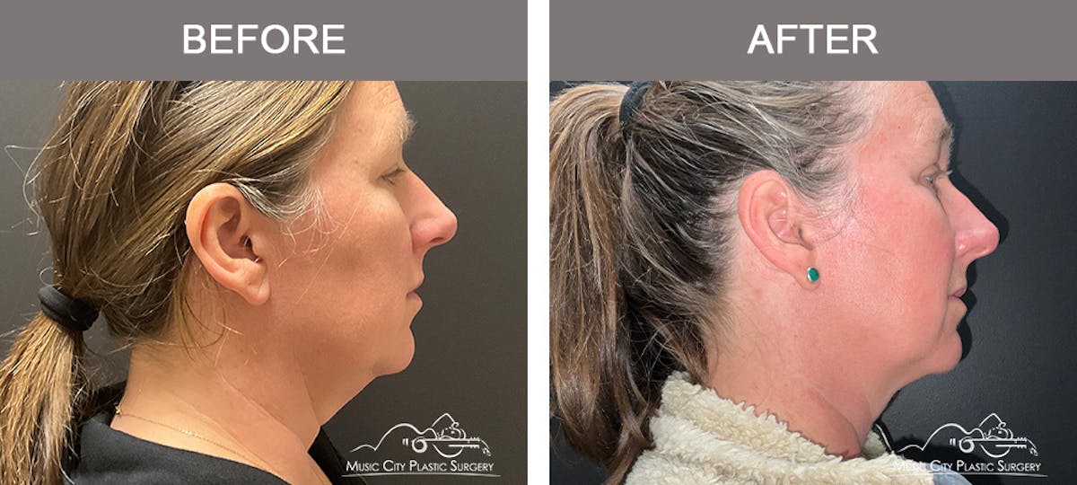 Facial Liposuction Before & After Gallery - Patient 221836 - Image 1