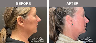 Facial Liposuction Before & After Gallery - Patient 221836 - Image 1