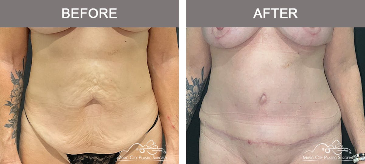 Abdominoplasty Before & After Gallery - Patient 358270 - Image 1
