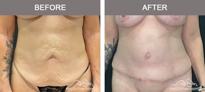 Abdominoplasty Before & After Gallery - Patient 358270 - Image 1