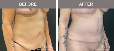 Abdominoplasty Before & After Gallery - Patient 358270 - Image 2