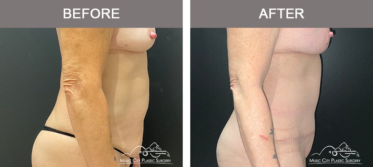 Abdominoplasty Before & After Gallery - Patient 358270 - Image 3