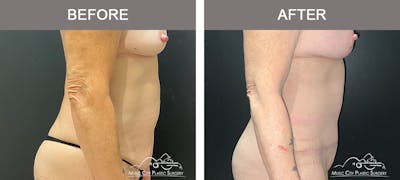 Abdominoplasty Before & After Gallery - Patient 358270 - Image 3