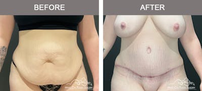 Abdominoplasty Before & After Gallery - Patient 143500 - Image 1