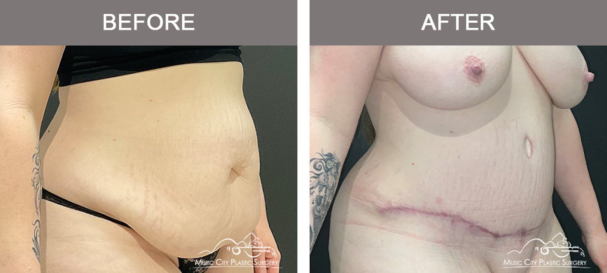 Abdominoplasty Before & After Gallery - Patient 143500 - Image 2