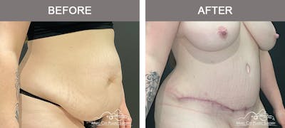 Abdominoplasty Before & After Gallery - Patient 143500 - Image 2