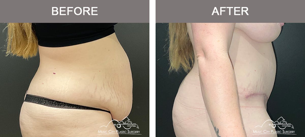 Abdominoplasty Before & After Gallery - Patient 143500 - Image 3