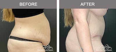 Abdominoplasty Before & After Gallery - Patient 143500 - Image 3