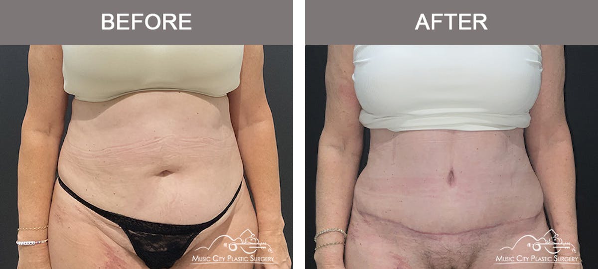 Abdominoplasty Before & After Gallery - Patient 220561 - Image 1