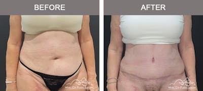 Abdominoplasty Before & After Gallery - Patient 220561 - Image 1
