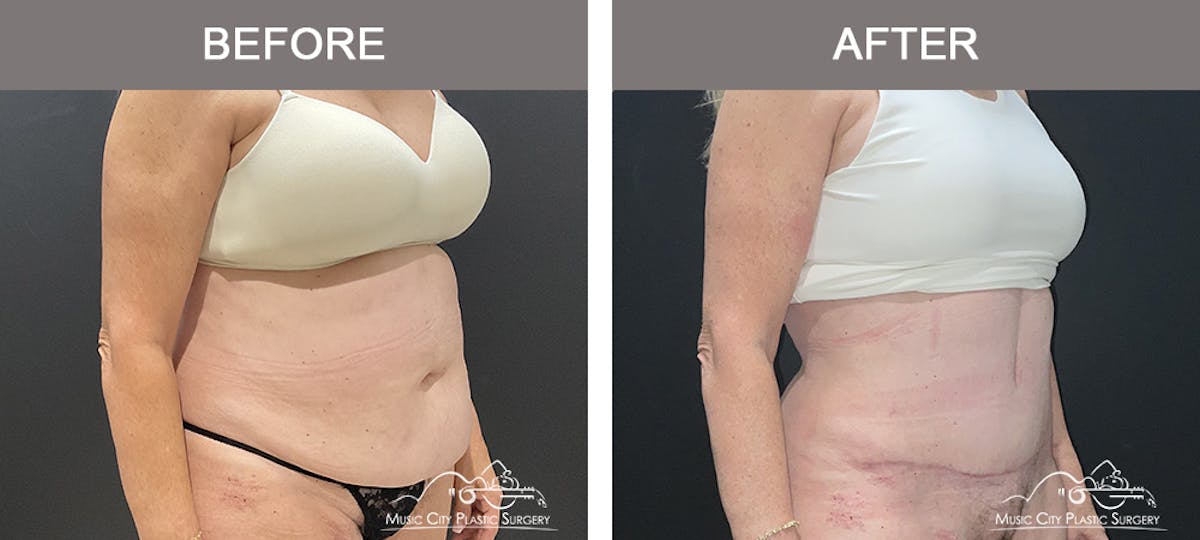 Abdominoplasty Before & After Gallery - Patient 220561 - Image 2