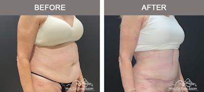 Abdominoplasty Before & After Gallery - Patient 220561 - Image 2