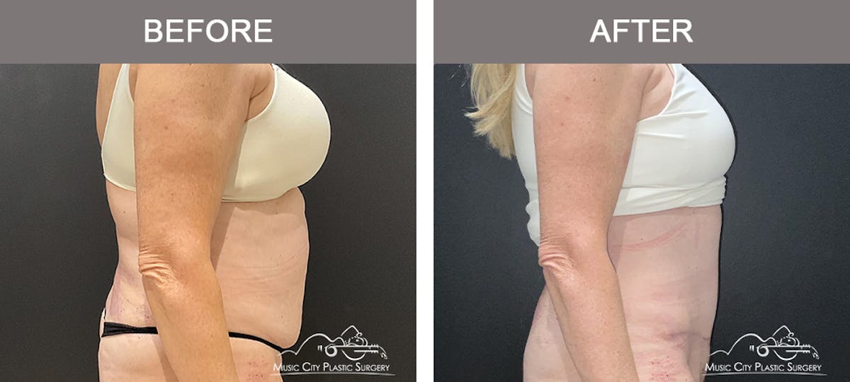 Abdominoplasty Before & After Gallery - Patient 220561 - Image 3