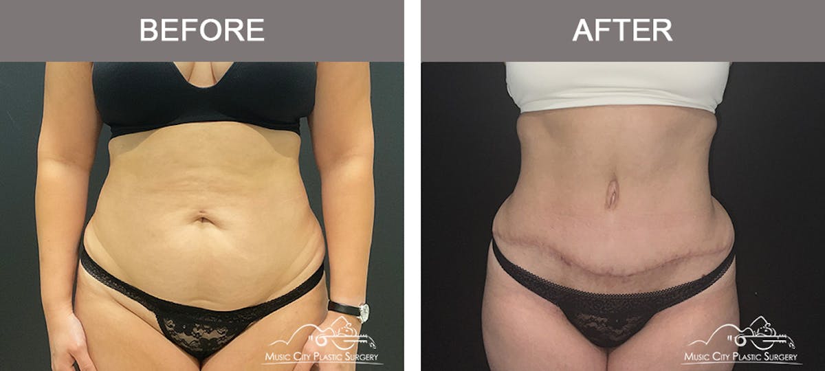 Abdominoplasty Before & After Gallery - Patient 122643 - Image 1