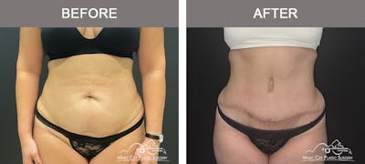 Abdominoplasty Before & After Gallery - Patient 122643 - Image 1