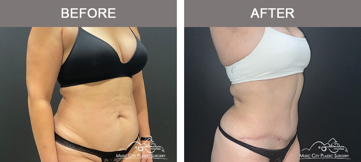 Abdominoplasty Before & After Gallery - Patient 122643 - Image 2