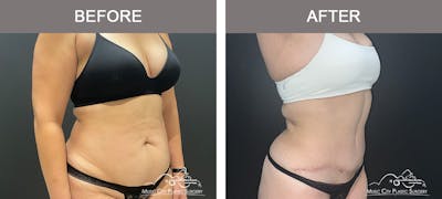 Abdominoplasty Before & After Gallery - Patient 122643 - Image 2