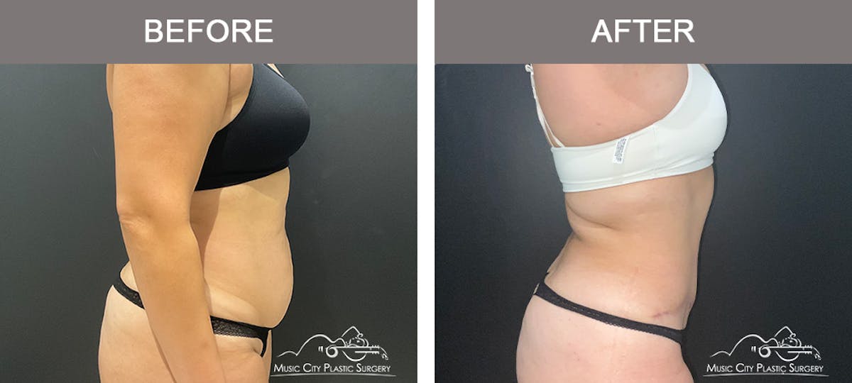 Abdominoplasty Before & After Gallery - Patient 122643 - Image 3