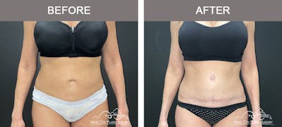 Abdominoplasty Before & After Gallery - Patient 185826 - Image 1