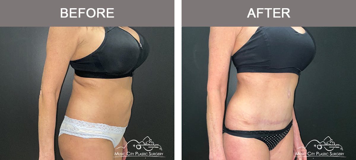 Abdominoplasty Before & After Gallery - Patient 185826 - Image 2