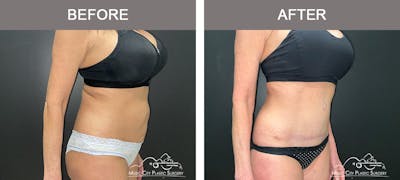 Abdominoplasty Before & After Gallery - Patient 185826 - Image 2