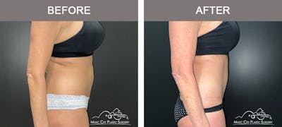 Abdominoplasty Before & After Gallery - Patient 185826 - Image 3