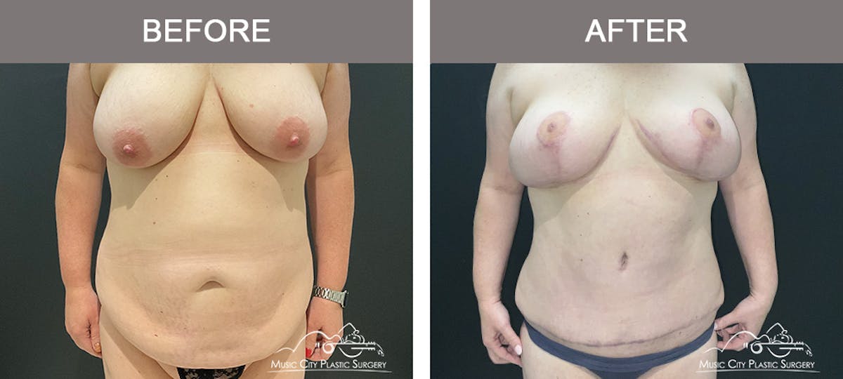 Abdominoplasty Before & After Gallery - Patient 268751 - Image 1