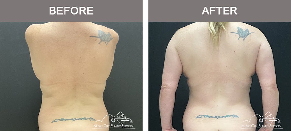 Abdominoplasty Before & After Gallery - Patient 268751 - Image 3