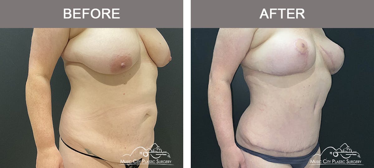 Abdominoplasty Before & After Gallery - Patient 268751 - Image 2