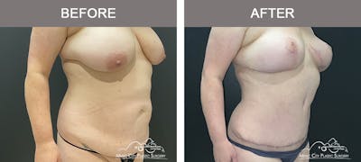 Abdominoplasty Before & After Gallery - Patient 268751 - Image 2