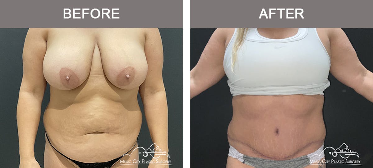 Abdominoplasty Before & After Gallery - Patient 233183 - Image 1