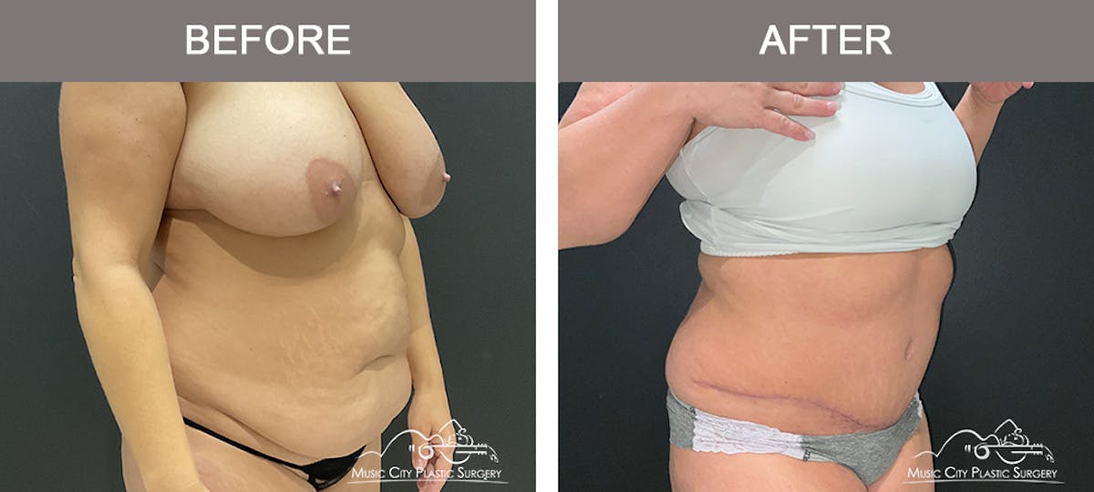 Abdominoplasty Before & After Gallery - Patient 233183 - Image 2