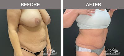 Abdominoplasty Before & After Gallery - Patient 233183 - Image 2
