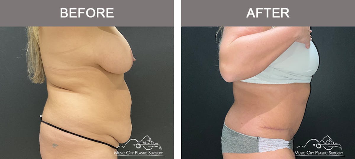 Abdominoplasty Before & After Gallery - Patient 233183 - Image 3