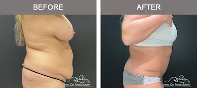 Abdominoplasty Before & After Gallery - Patient 233183 - Image 3
